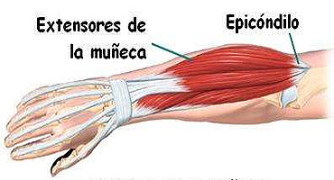 Pdel Saludable: Cmo identificar la Epicondilitis