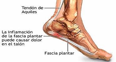 Qu es la fascia plantar y qu es una fascitis plantar?